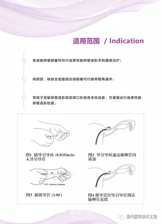 正邦醫(yī)學(xué)一次性使用輸卵管插入導(dǎo)管