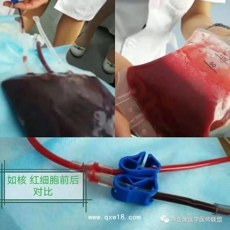 臭氧自體血血袋、三氧自體血血袋、一次性血袋