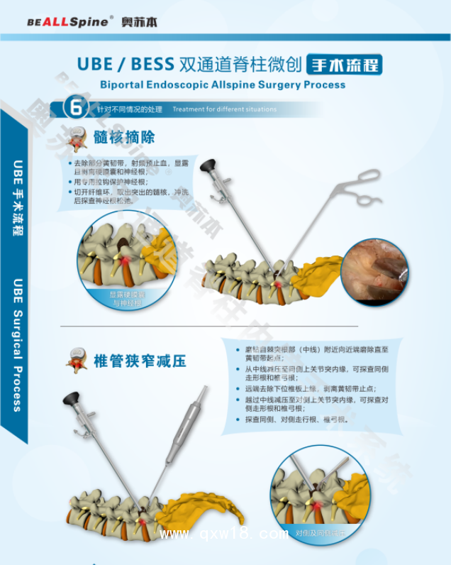山東奧蘇本UBE雙通道脊柱內(nèi)鏡微創(chuàng)手術(shù)系統(tǒng)