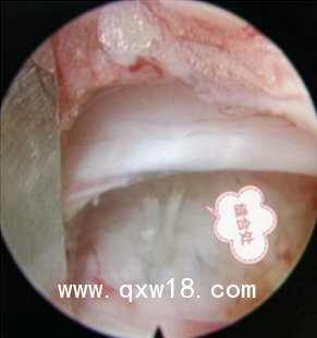 一次性纖維環(huán)縫合器