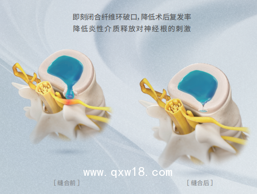 骨科專用非帶量耗材一次性纖維環(huán)縫合器