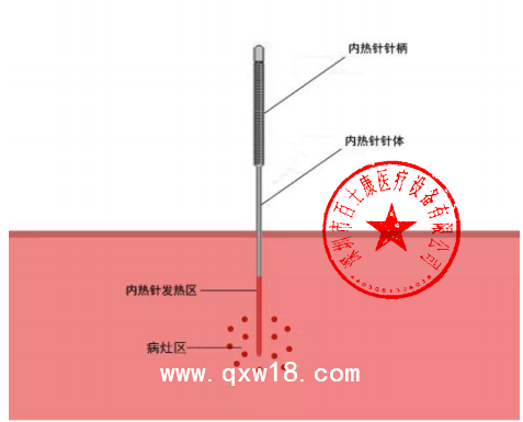 百士康 型號NRZ-40R-B 內(nèi)熱針治療儀