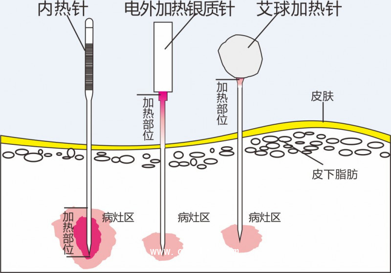 內(nèi)熱針治療儀針灸針 全國地區(qū)招商