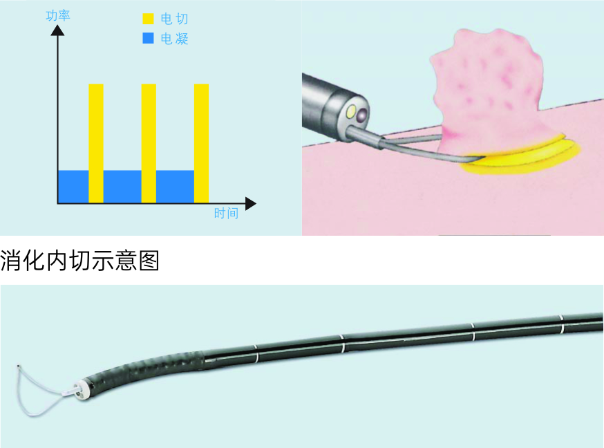 消化內(nèi)切示意圖
